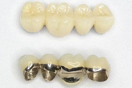 審美歯科（白い詰め物・被せ物の種類） - アクア歯科（箕面市船場西）